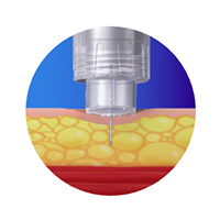 4mm length by 32 gauge needle